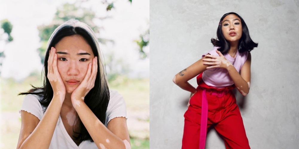 Fakta dan Profil Zsazsa Caesar, Model Cantik yang Pernah Dibully Karena Vitiligo