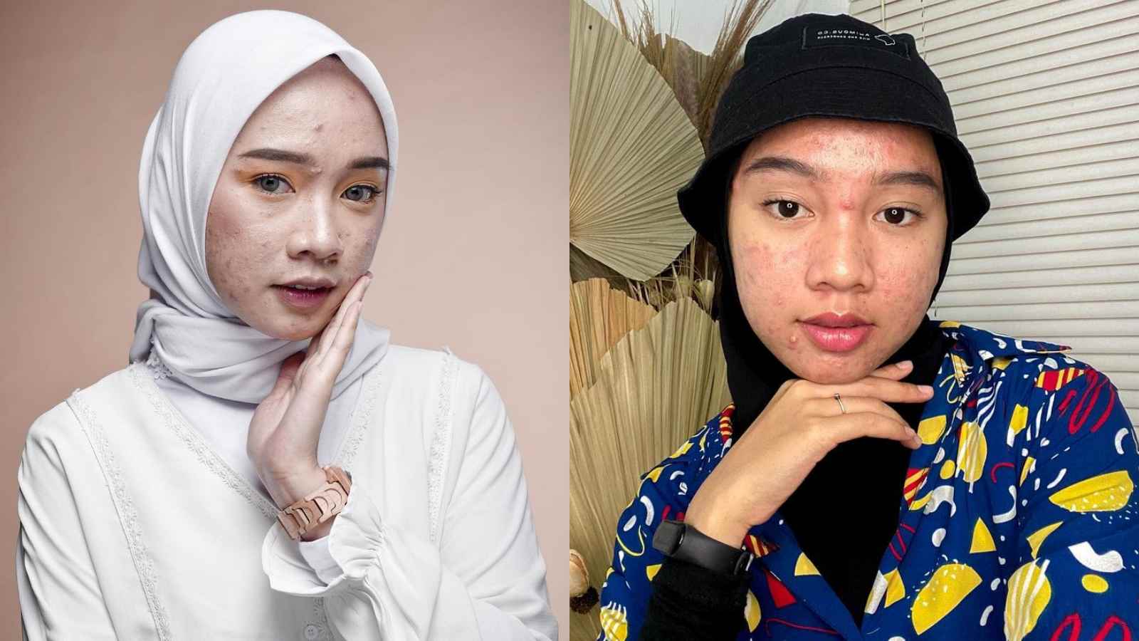 Fakta-fakta Unik Novia Nur Ismi, Selebgram asal Cianjur yang Kisah Wajah Jerawatnya Bikin Semangat Netizen