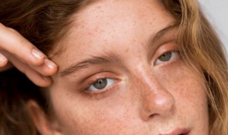 Diperingati Setiap 22 November, Inilah Fakta dan Sejarah Love Your Freckles Day