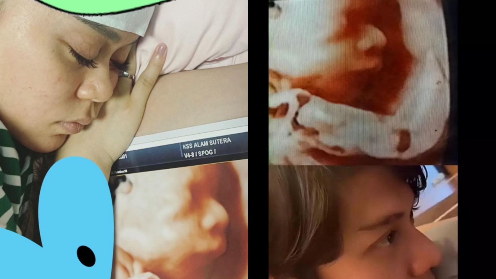 Miliki Hidung Mancung, Dokter Bocorkan Tanggal Kelahiran Anak Lesti Kejora dan Rizky Billar
