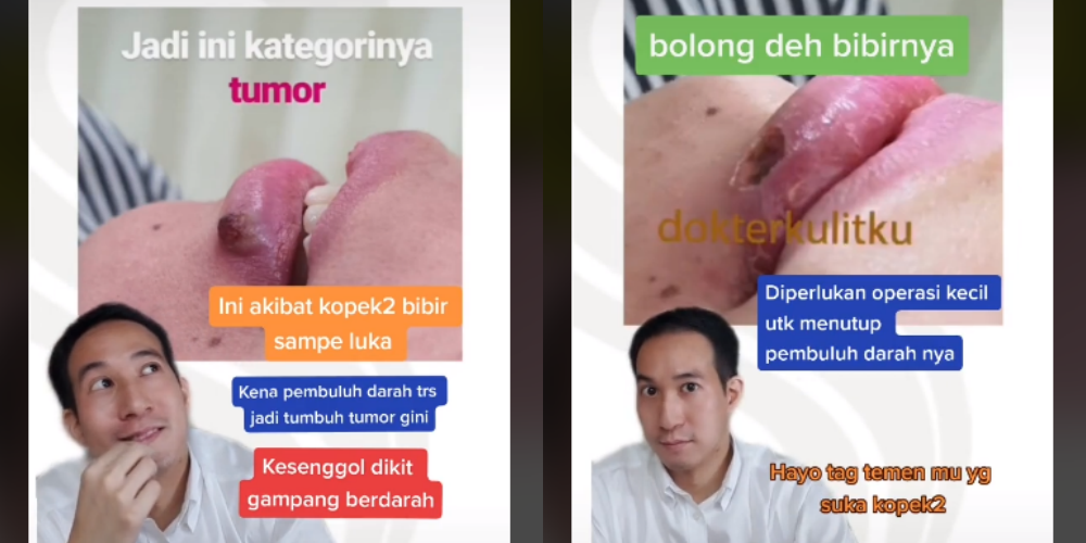 Bikin Ngeri, Cerita Pasien Idap Tumor Akibat Hobi Kelupas Kulit Bibir, Auto Viral di TikTok